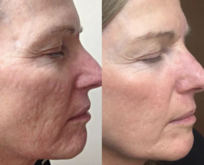 SkinGlow resultaat fijne lijntjes