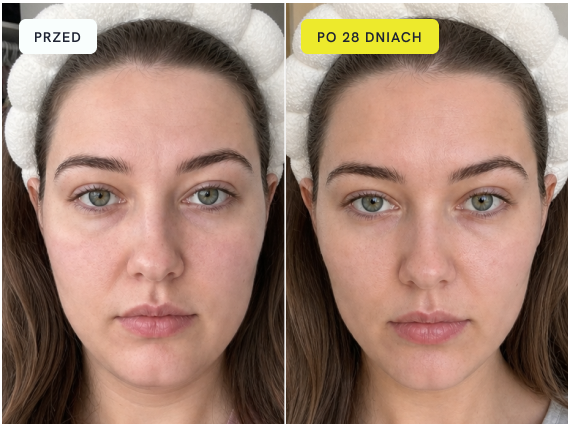 SkinGlow resultaat gezichtscontour
